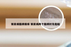 银屑病胳膊瘙痒 银屑病两个胳膊肘先粗糙
