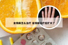 金钱癣怎么治疗 金钱癣治疗后扩大了