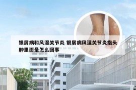 银屑病和风湿关节炎 银屑病风湿关节炎指头肿里面是怎么回事