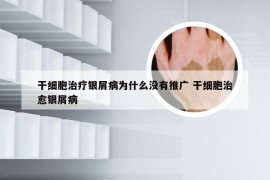 干细胞治疗银屑病为什么没有推广 干细胞治愈银屑病