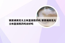 银屑病用完凡士林直接擦药吗 银屑病用完凡士林直接擦药吗会好吗
