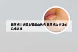 银屑病旳病因主要是血热吗 银屑病血热证的临床表现