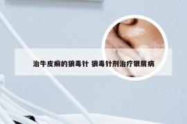 治牛皮癣的狼毒针 狼毒针剂治疗银屑病