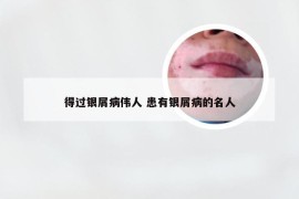 得过银屑病伟人 患有银屑病的名人