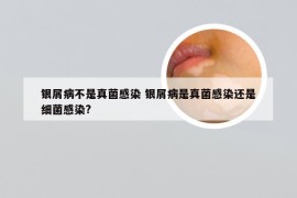 银屑病不是真菌感染 银屑病是真菌感染还是细菌感染?