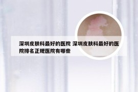 深圳皮肤科最好的医院 深圳皮肤科最好的医院排名正规医院有哪些