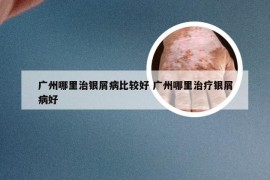 广州哪里治银屑病比较好 广州哪里治疗银屑病好