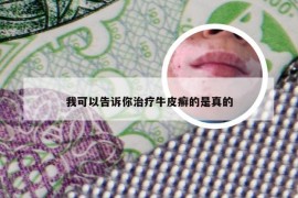 我可以告诉你治疗牛皮癣的是真的