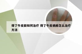 得了牛皮藓如何治疗 得了牛皮病癣怎么治疗方法