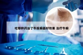 吃那种药冶了牛反癣最好效果 治疗牛癣