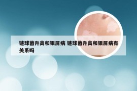 链球菌升高和银屑病 链球菌升高和银屑病有关系吗