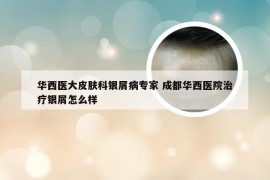 华西医大皮肤科银屑病专家 成都华西医院治疗银屑怎么样