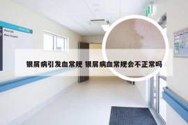 银屑病引发血常规 银屑病血常规会不正常吗