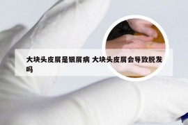 大块头皮屑是银屑病 大块头皮屑会导致脱发吗