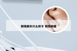 铜钱癣长什么样子 铜钱癣图