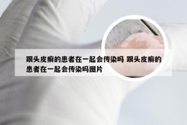 跟头皮癣的患者在一起会传染吗 跟头皮癣的患者在一起会传染吗图片