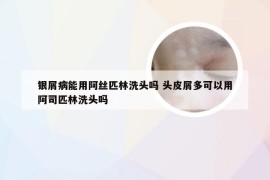 银屑病能用阿丝匹林洗头吗 头皮屑多可以用阿司匹林洗头吗