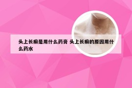 头上长癣是用什么药膏 头上长癣的原因用什么药水