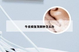 牛皮癣复发脚肿怎么办