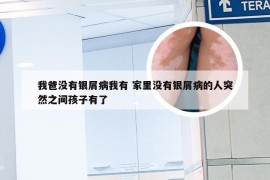 我爸没有银屑病我有 家里没有银屑病的人突然之间孩子有了