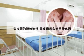 头皮藓的特效治疗 头皮癣怎么治用什么药