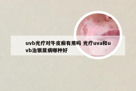 uvb光疗对牛皮癣有用吗 光疗uva和uvb治银屑病哪种好