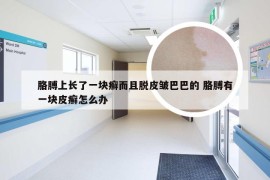 胳膊上长了一块癣而且脱皮皱巴巴的 胳膊有一块皮癣怎么办