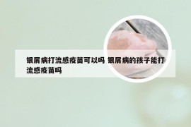 银屑病打流感疫苗可以吗 银屑病的孩子能打流感疫苗吗