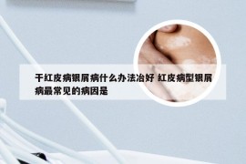 干红皮病银屑病什么办法冶好 红皮病型银屑病最常见的病因是