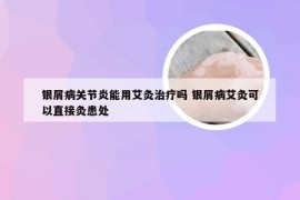 银屑病关节炎能用艾灸治疗吗 银屑病艾灸可以直接灸患处
