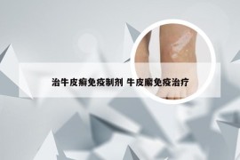 治牛皮癣免疫制剂 牛皮廨免疫治疗