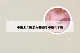 手指上长癣怎么引起的 手指长了癣