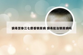 狼毒苦参三七麝香银屑病 狼毒能治银屑病吗