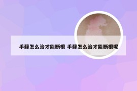 手藓怎么治才能断根 手藓怎么治才能断根呢