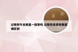过敏和牛皮癣是一回事吗 过敏性皮疹和银屑病区别