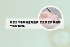 吴忠治疗牛皮癣正规医院 宁夏吴忠皮肤病哪个医院看的好
