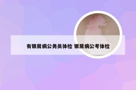 有银屑病公务员体检 银屑病公考体检