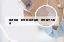 银屑病吃一只螃蟹 银屑病吃一只螃蟹会怎么样