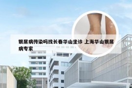 银屑病传染吗找长春华山坐诊 上海华山银屑病专家