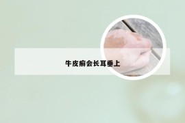 牛皮癣会长耳垂上
