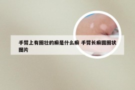 手臂上有圈壮的癣是什么癣 手臂长癣圆圈状图片