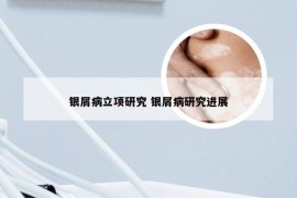 银屑病立项研究 银屑病研究进展