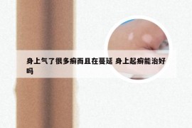 身上气了很多癣而且在蔓延 身上起癣能治好吗