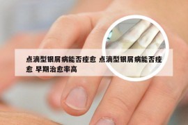 点滴型银屑病能否痊愈 点滴型银屑病能否痊愈 早期治愈率高