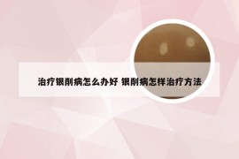 治疗银削病怎么办好 银削病怎样治疗方法