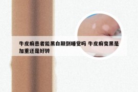 牛皮癣患者能黑白颠倒睡觉吗 牛皮癣变黑是加重还是好转