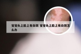 宝宝头上脸上有白斑 宝宝头上脸上有白斑怎么办