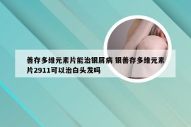 善存多维元素片能治银屑病 银善存多维元素片2911可以治白头发吗