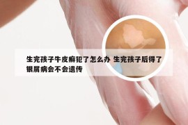 生完孩子牛皮癣犯了怎么办 生完孩子后得了银屑病会不会遗传