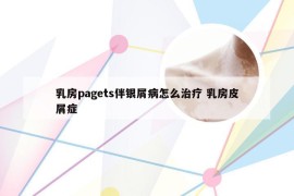乳房pagets伴银屑病怎么治疗 乳房皮屑症
